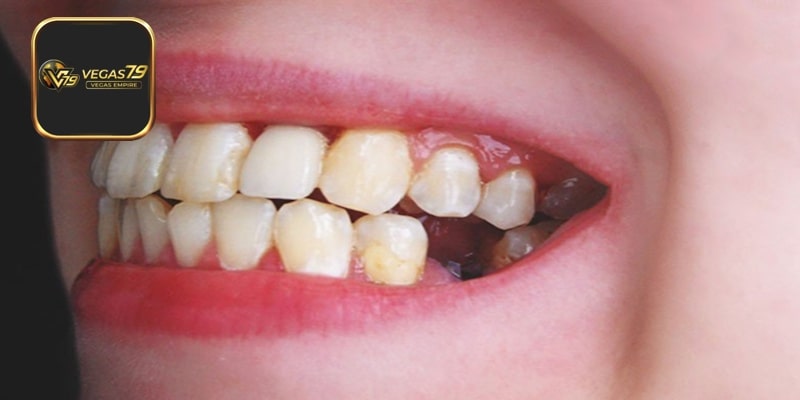 Giải mã mơ thấy rụng răng ở người khác