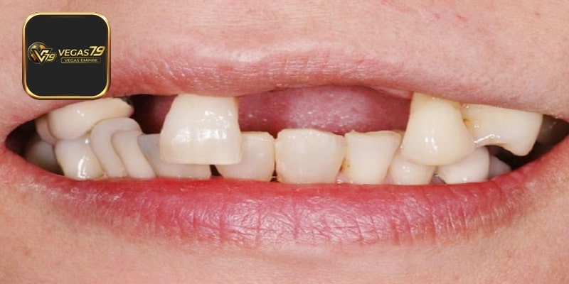 Mơ Thấy Rụng Răng Mang Thông Điệp Và Đánh Số Gì?